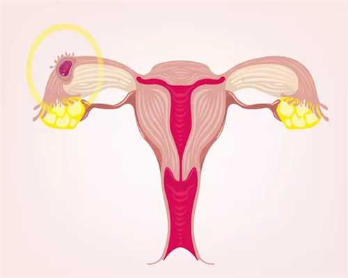泰国代妈：患有卵巢囊肿会影响代孕吗 www.yidia